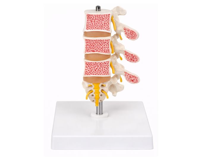 Model of osteoporosis 3 bones