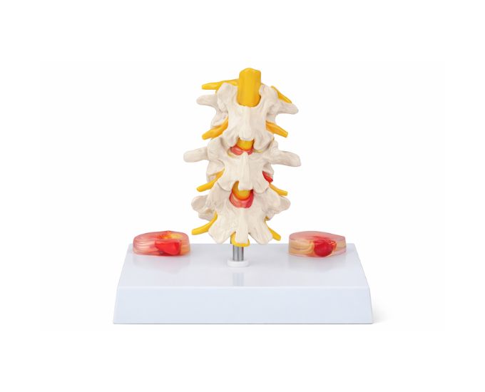 Intervertebral Disc With Pathologic Symptom Life Size Model