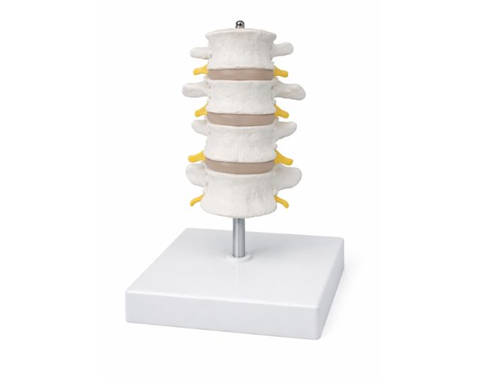 Intervertebral Disc With Pathologic Symptom Model