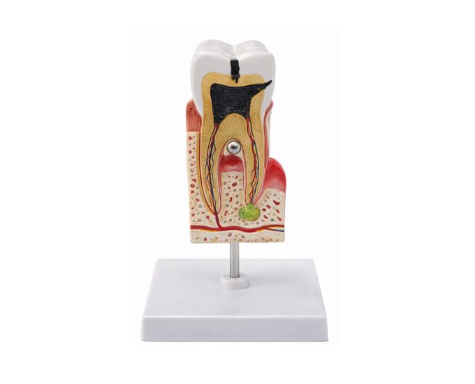 Tooth Common Disease Anatomy Model - Product Image