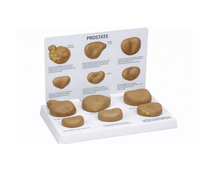 Pathological Prostate Anatomy Model for Clinical Study - Product Image