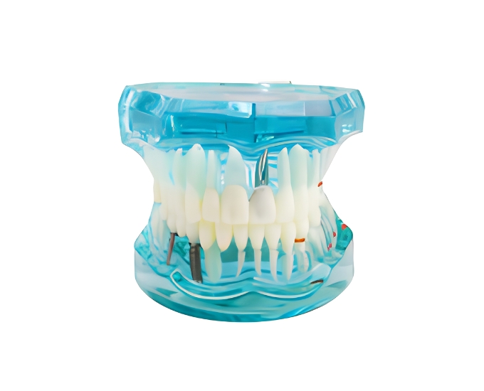 Transparent Dental Implantation Tooth Anatomical Model - Product Image