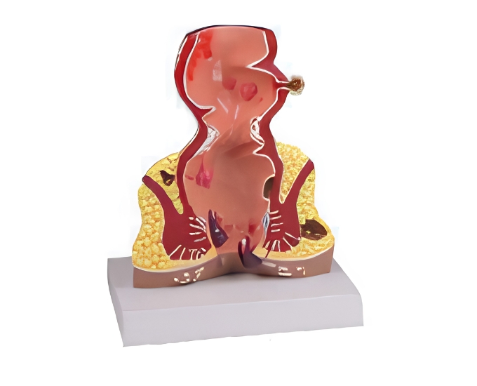 Hemorrhoids Model - Product Image