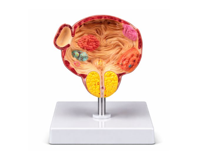 Bladder and Prostate Pathology Model 5X Enlarged 3 Parts - Product Image