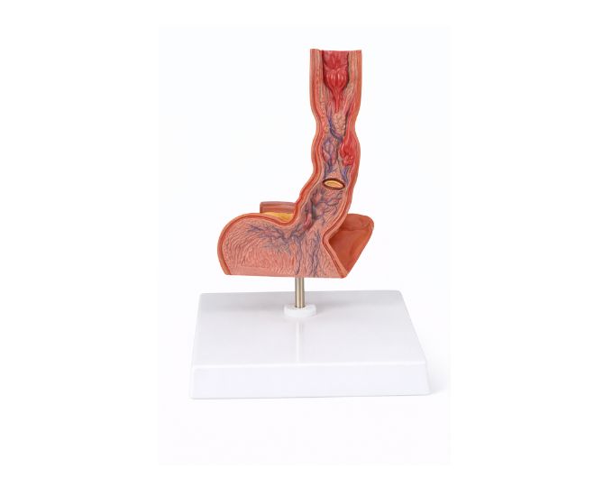 Diseased Esophagus Pathology Teaching Model - Product Image