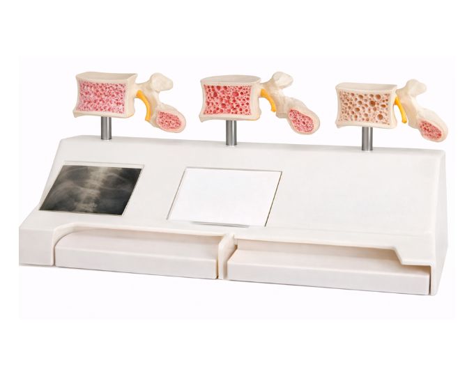 Osteoporosis Model Life Size 3 Parts