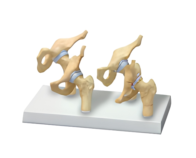 4 Stages Osteoarthritis Hip Model - Product Image
