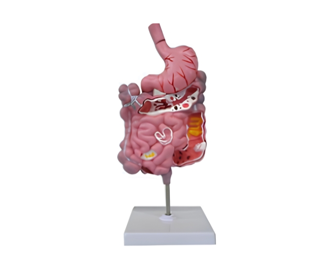 Diseased Digestive System Model - Product Image