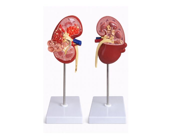 Kidney Dissection Model Showing Cystic Condition - Product Image