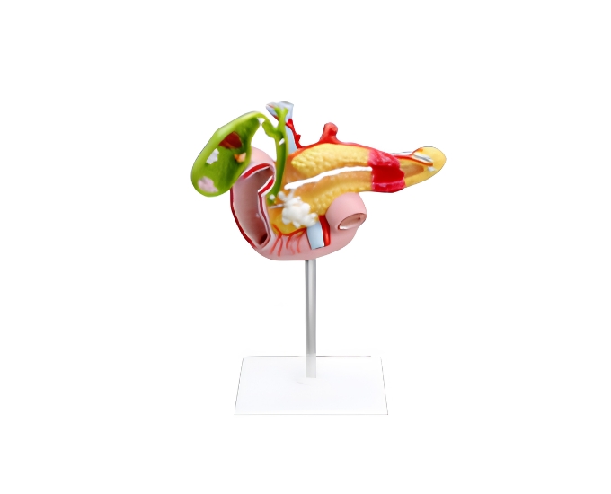 Diseased Pancreas, Spleen and Gall Bladder Model - Product Image