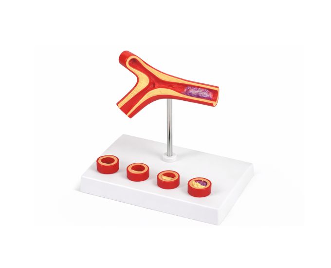 Atherosclerosis and Thrombosis Study Model for Pathology - Product Image