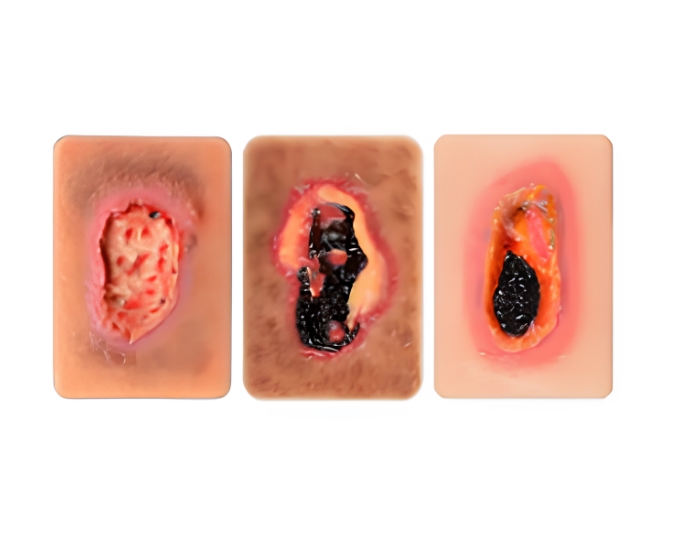 Pocket Necrotic Tissue Wound Card Model (3 Types) - Product Image