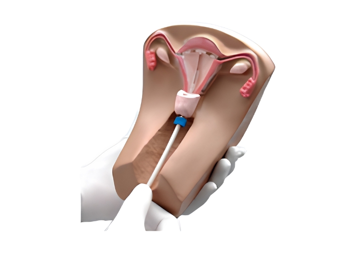 IUD Training Model (Transparent Coronal Section) - Product Image