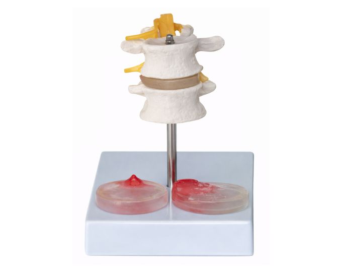 Intervertebral disc with pathologic symptom model