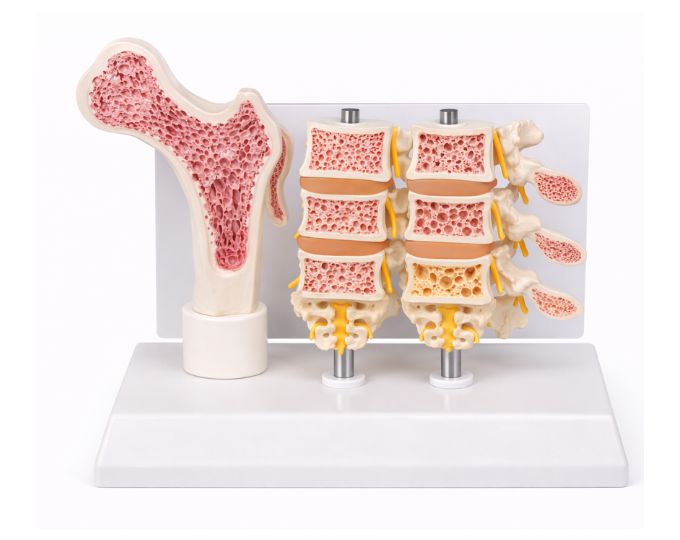 Osteoporosis bone model life size