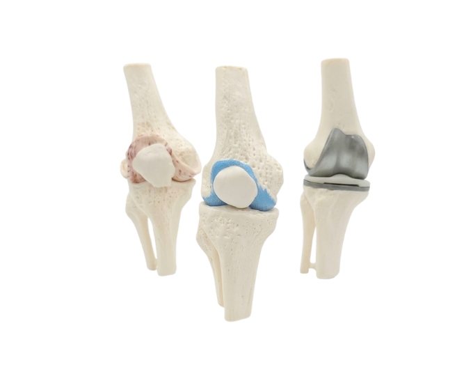3 Stage Arthritis Knee Model with Implant - Product Image
