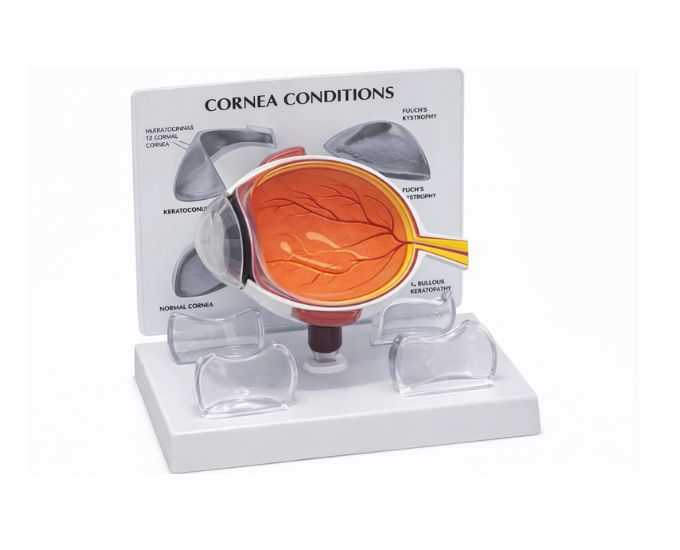 Human Eye Model with Pathological Cornea - Product Image