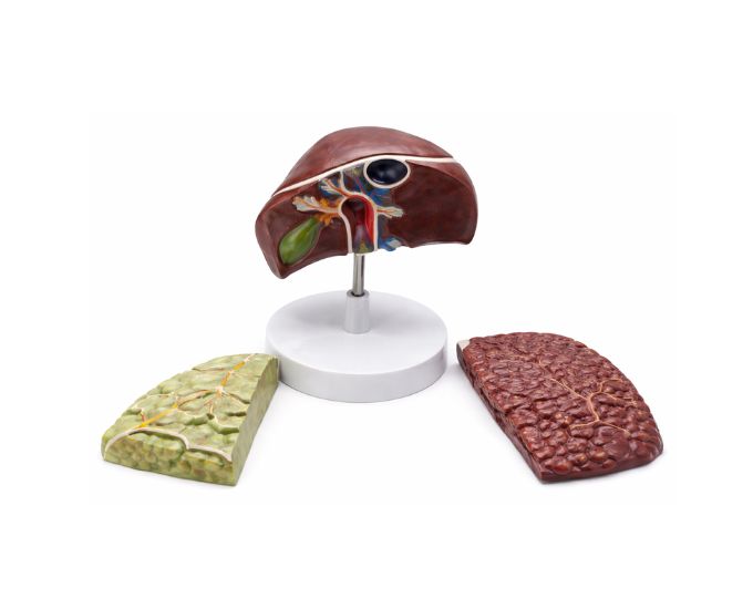 Life Size Liver Cancer Anatomical Teaching Model - Product Image