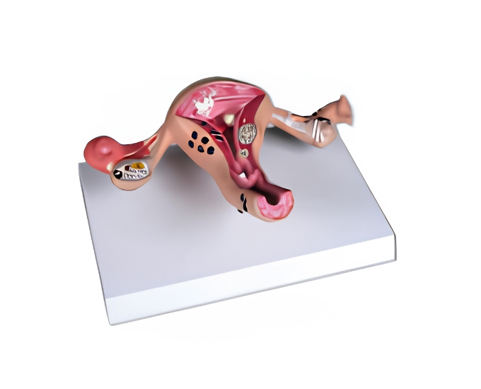 Diseased Uterus Model - Product Image
