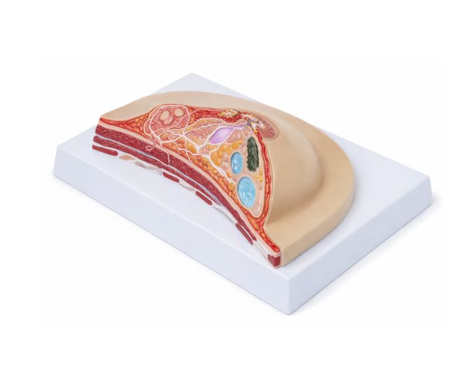 Life Size Pathological Breast Study Model - Product Image