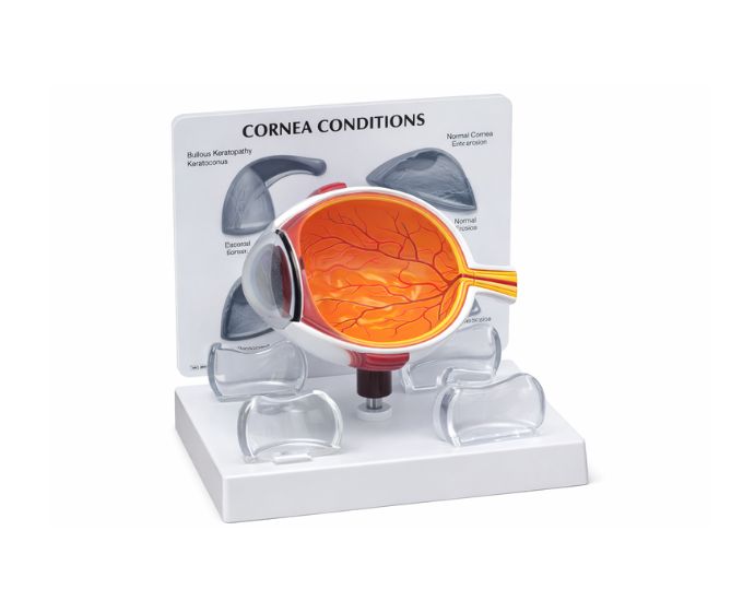 Human Eye Model with Pathological Cornea