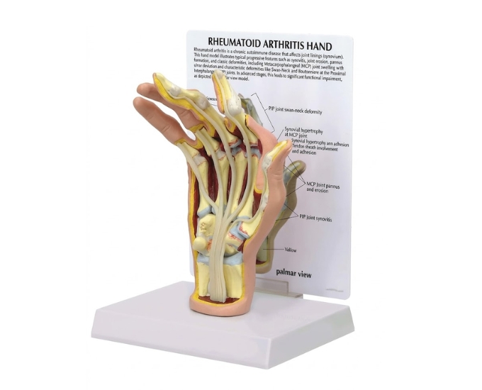Hand Rheumatoid Arthritis Anatomical Model - Product Image