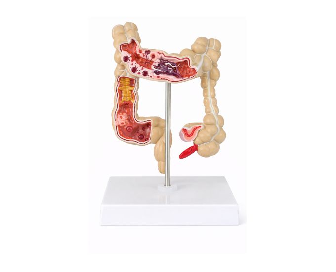 Diseased Large Intestine Anatomy Model for Study - Product Image