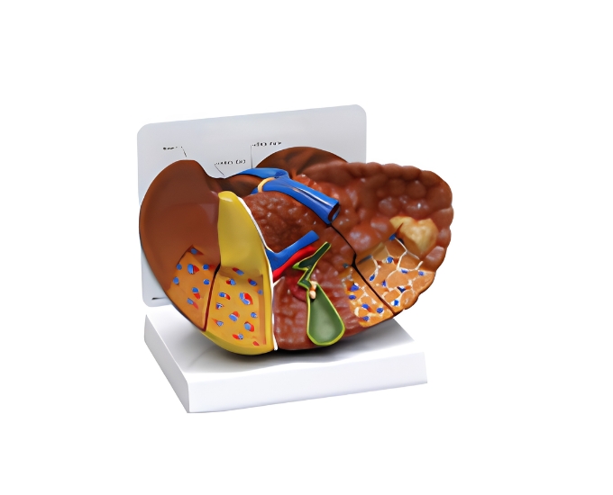 Diseased Liver Model - Product Image