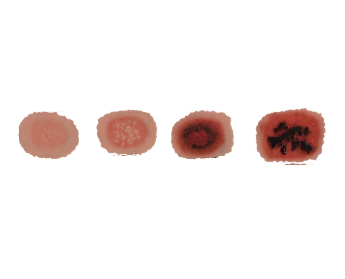 1st–4th Degree Skin Burn Wound Moulage - Product Image