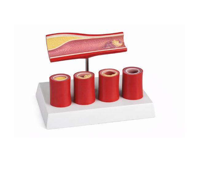 Thrombosis Anatomy Demonstration Model for Vascular Study - Product Image