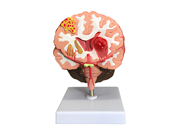 Brain Stroke Model - Product Image