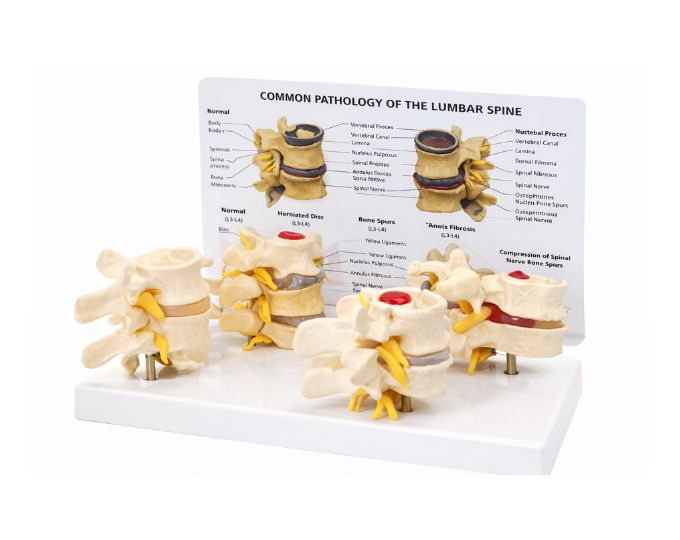 Pathological model of vertebrae with card
