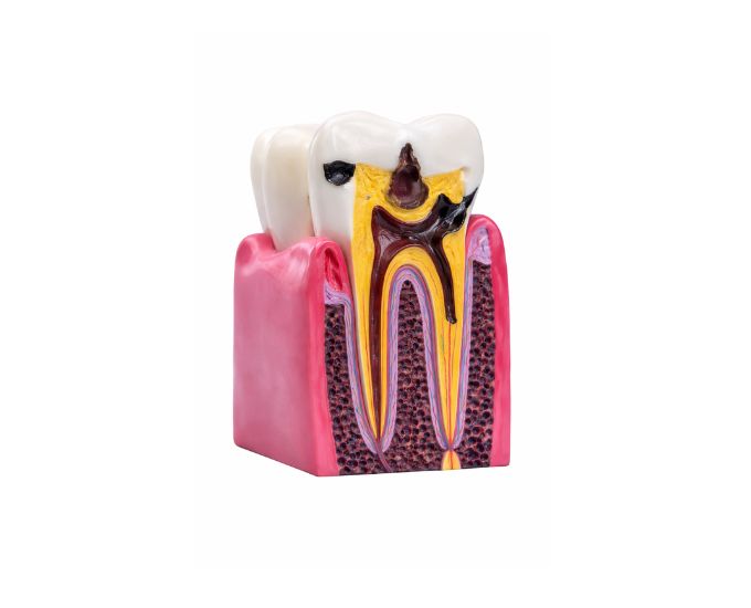 Maxillary Teeth Caries Model 2 Parts for Dental Anatomy Study - Product Image