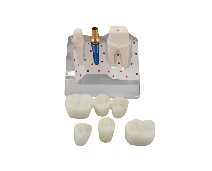 Transparent Enlarged Dental Implant Anatomy Model - Product Image