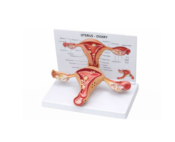 Pathological Uterus Anatomy Model for Gynecology Study - Product Image