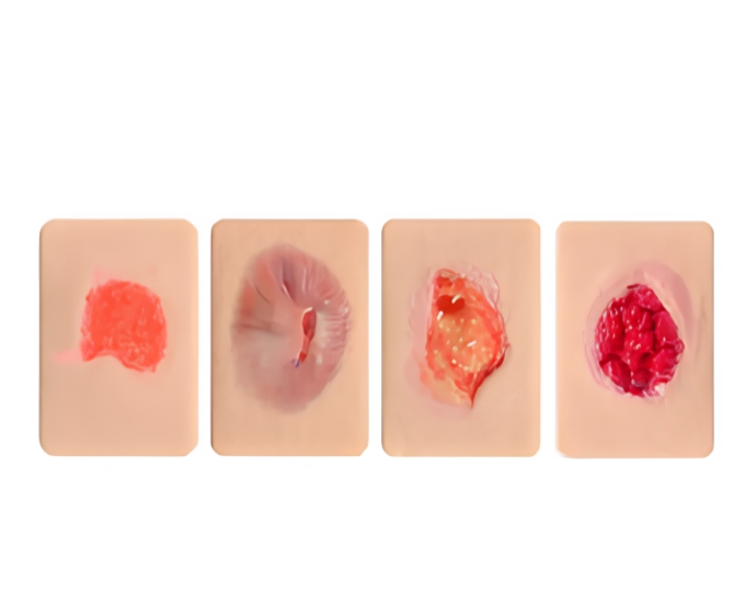 Pocket Granulation Tissue Wound Model Set - Product Image