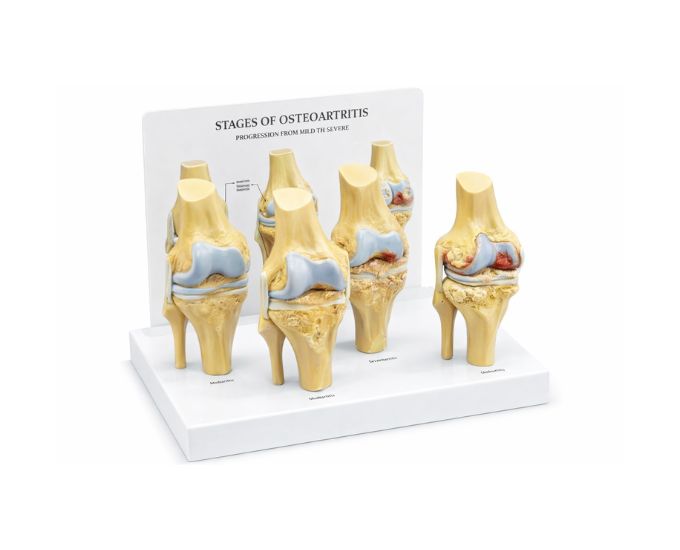 Pathological Knee Joint Anatomy Model with Study Card - Product Image