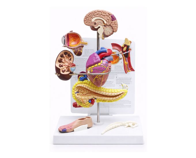 Diabetes Awareness and Pathology Teaching Model for Medical Study - Product Image