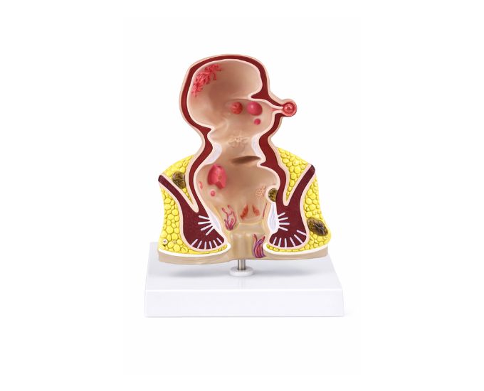 Rectum Disease Study Model for Medical Training - Product Image